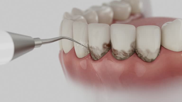 Trusted Wisdom Tooth Removal service in DeLisle, MS - Dentist Open Now